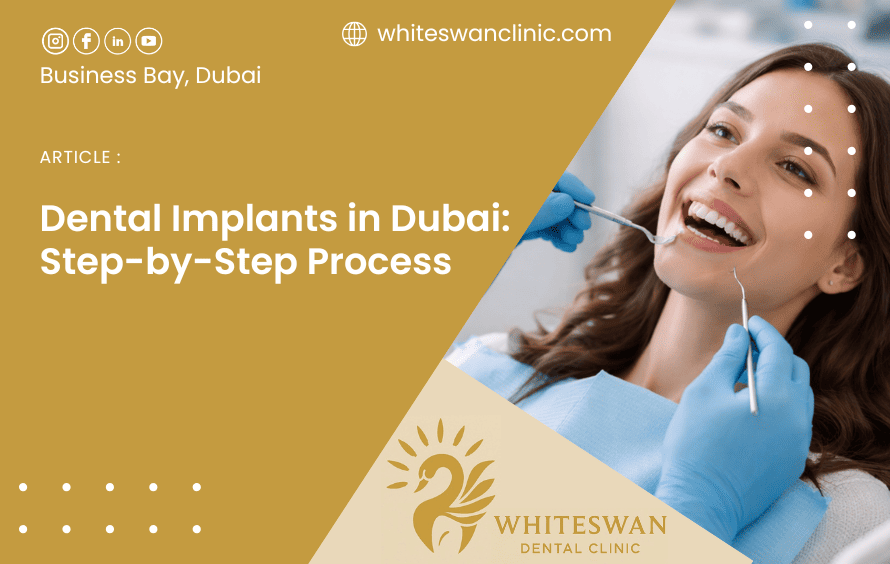 Dental Implants in Dubai: Step-by-Step Process