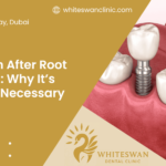 Crown After Root Canal: Why It’s Often Necessary