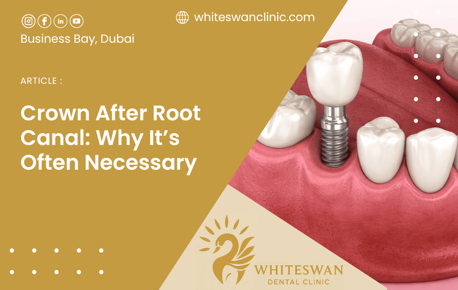 Crown After Root Canal: Why It’s Often Necessary