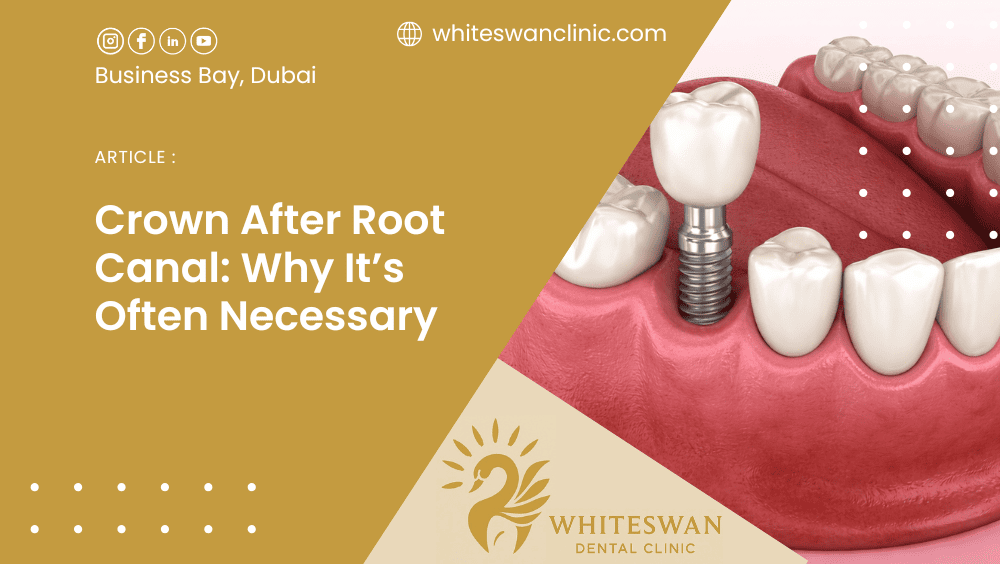 Crown After Root Canal: Why It’s Often Necessary