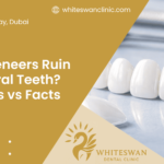 Do Veneers Ruin Natural Teeth? Myths vs Facts