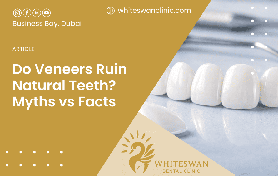 Do Veneers Ruin Natural Teeth? Myths vs Facts