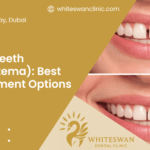 Gap Teeth (Diastema): Best Treatment Options