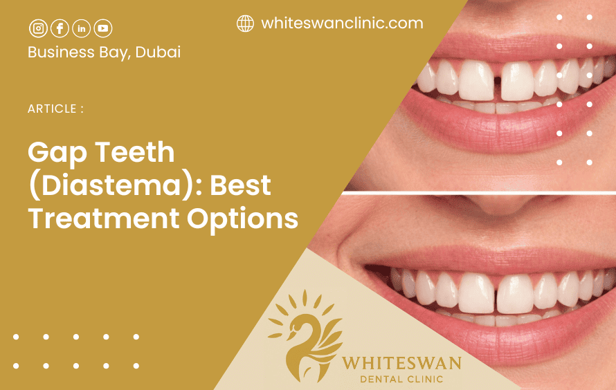 Gap Teeth (Diastema): Best Treatment Options