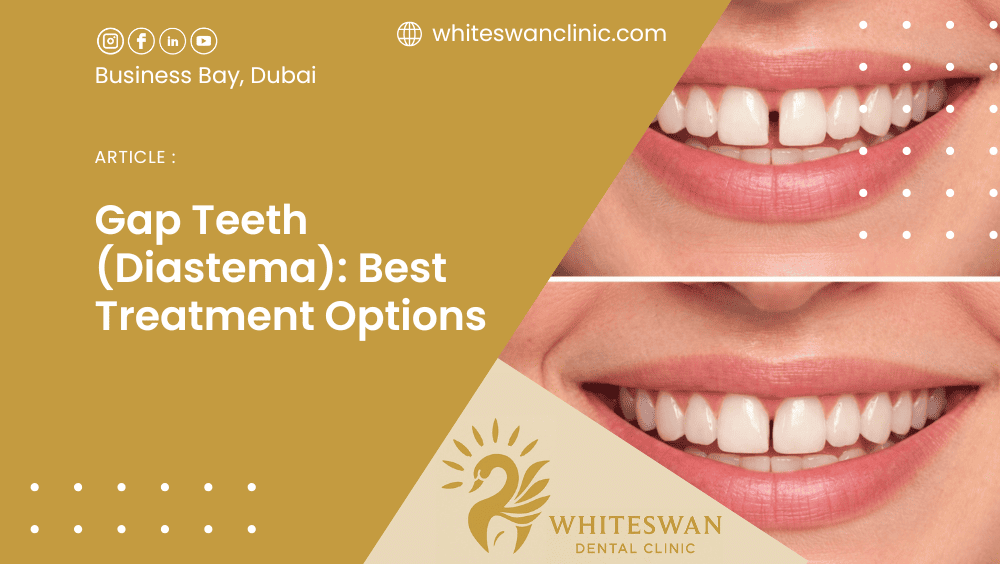 Gap Teeth (Diastema): Best Treatment Options