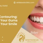 Gum Contouring: When Your Gums Affect Your Smile