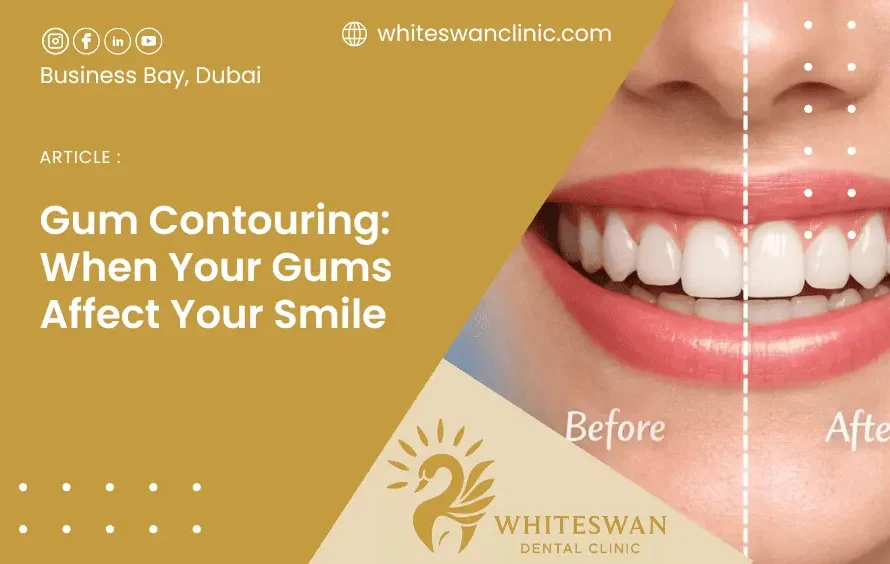 Gum Contouring: When Your Gums Affect Your Smile