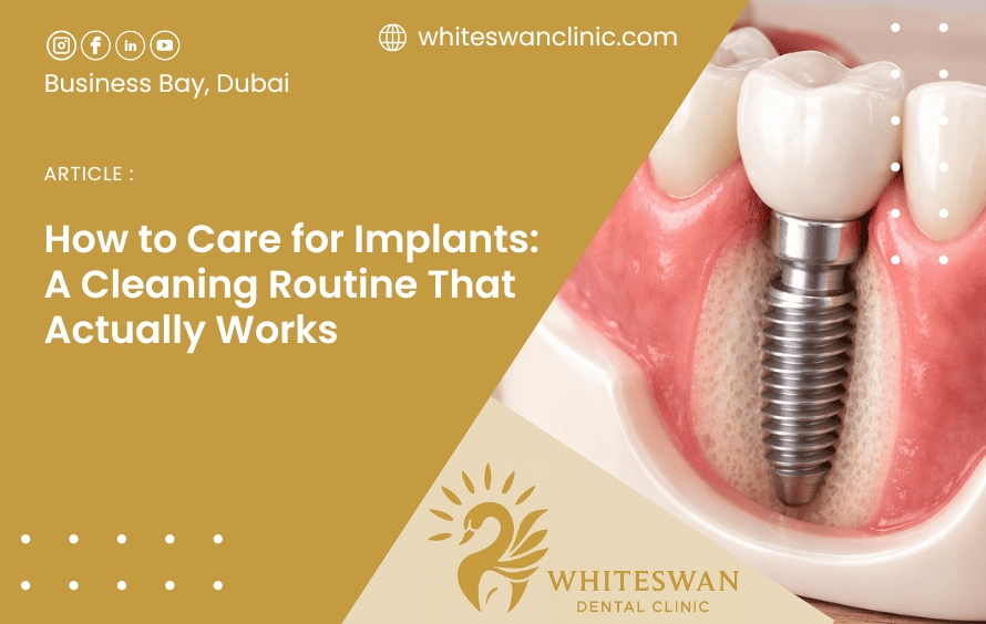 How to Care for Implants: A Cleaning Routine That Actually Works