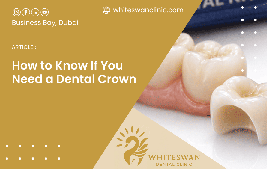 How to Know If You Need a Dental Crown