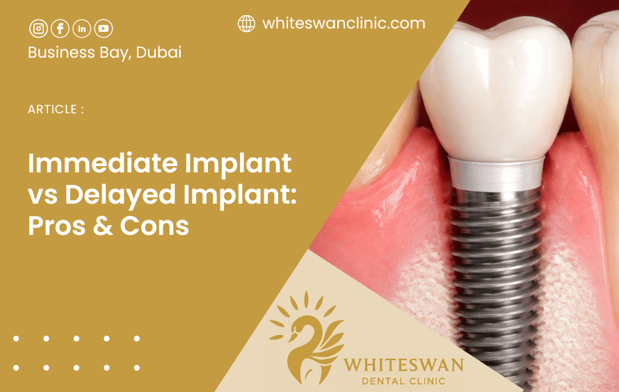 Immediate Implant vs Delayed Implant: Pros & Cons