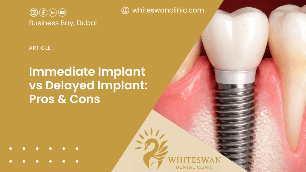 Immediate Implant vs Delayed Implant: Pros & Cons