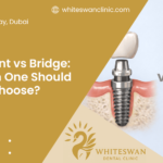 Implant vs Bridge: Which One Should You Choose?