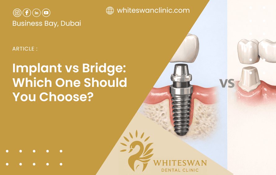 Implant vs Bridge: Which One Should You Choose?