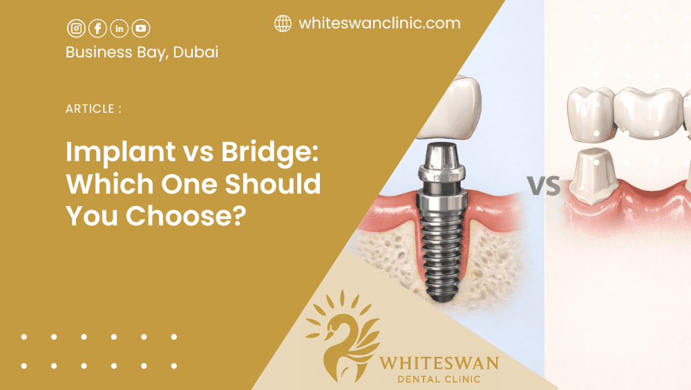 Implant vs Bridge: Which One Should You Choose?