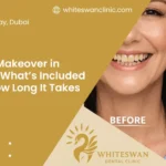 Smile Makeover in Dubai: What’s Included and How Long It Takes