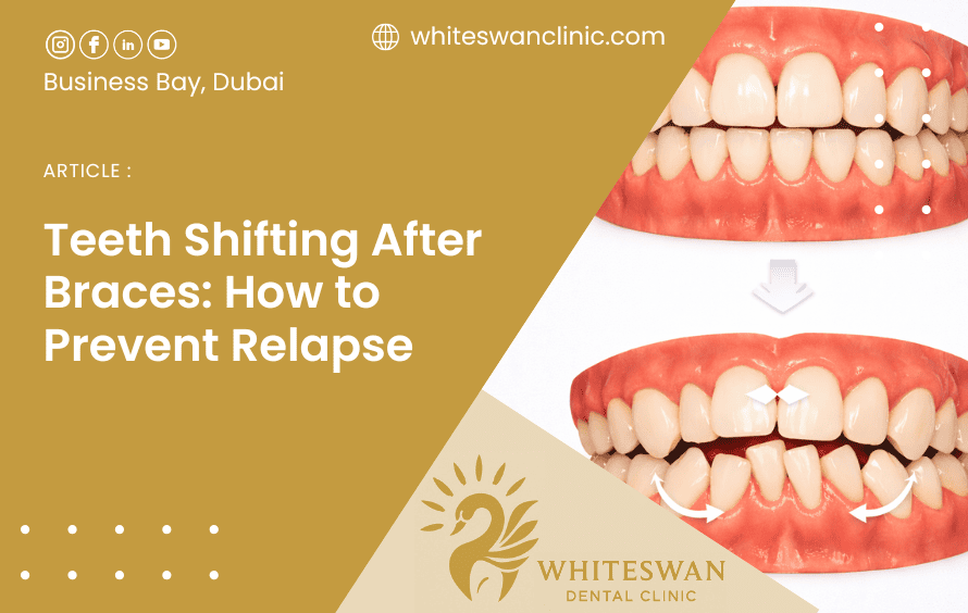 Teeth Shifting After Braces: How to Prevent Relapse