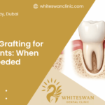 Bone Grafting for Implants: When It’s Needed