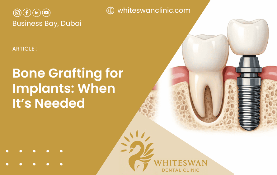 Bone Grafting for Implants: When It’s Needed
