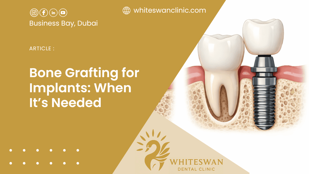 Bone Grafting for Implants: When It’s Needed