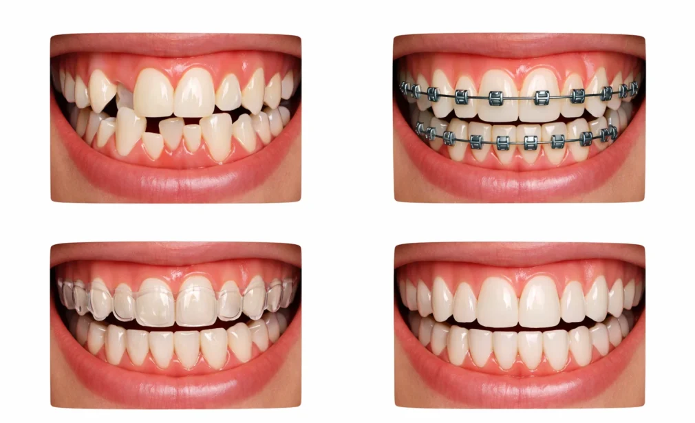 Crooked Teeth Treatment