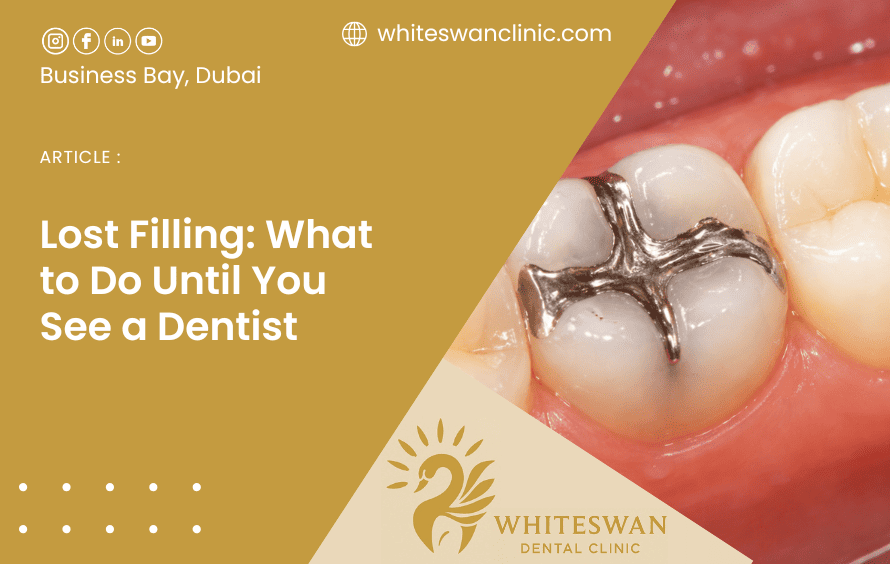 Lost Filling: What to Do Until You See a Dentist